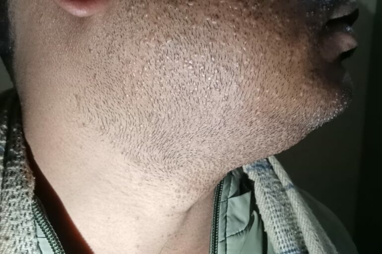 Warts for 1 Years and Chronic Allergic Rhinitis got cured in 10 Days !!!!!