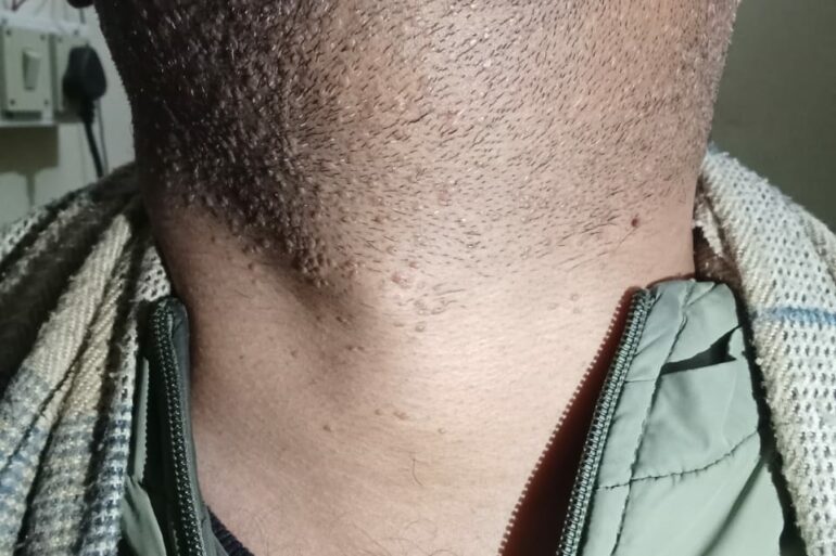 Warts for 1 Years and Chronic Allergic Rhinitis got cured in 10 Days !!!!!