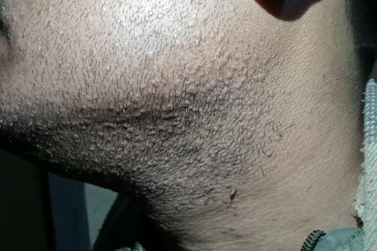 Warts for 1 Years and Chronic Allergic Rhinitis got cured in 10 Days !!!!!