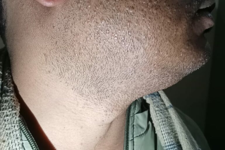 Warts for 1 Years and Chronic Allergic Rhinitis got cured in 10 Days !!!!!