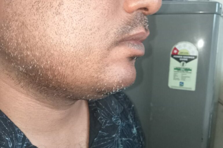 Warts for 1 Years and Chronic Allergic Rhinitis got cured in 10 Days !!!!!