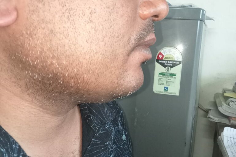 Warts for 1 Years and Chronic Allergic Rhinitis got cured in 10 Days !!!!!