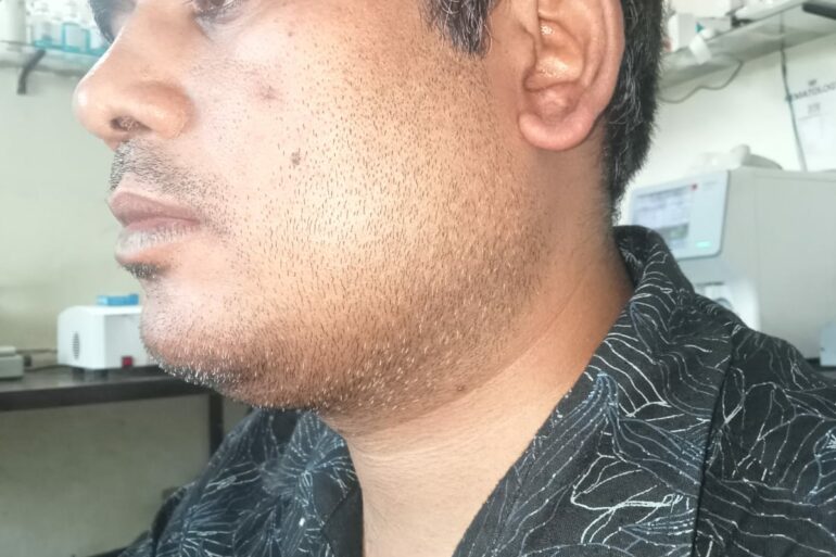 Warts for 1 Years and Chronic Allergic Rhinitis got cured in 10 Days !!!!!