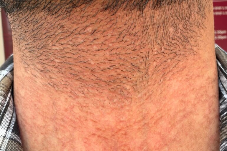 Flat Warts Cured in 15 Days Through Medicine Energy Transmission: A patient who wanted refund initially