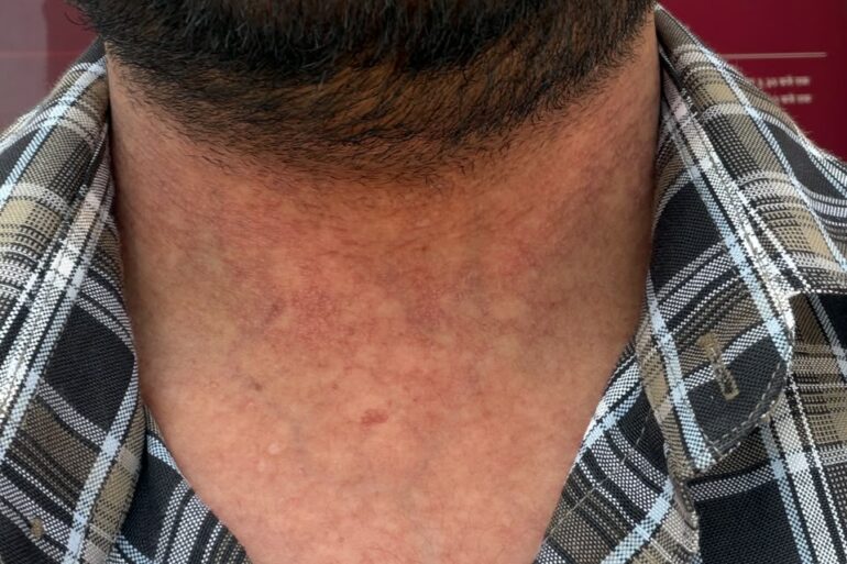 Flat Warts Cured in 15 Days Through Medicine Energy Transmission: A patient who wanted refund initially