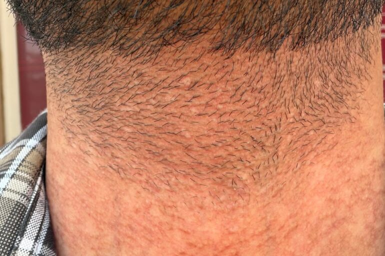 Flat Warts Cured in 15 Days Through Medicine Energy Transmission: A patient who wanted refund initially