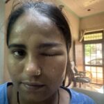 Nasolacrimal Duct Obstruction (Blocked Tear Duct)