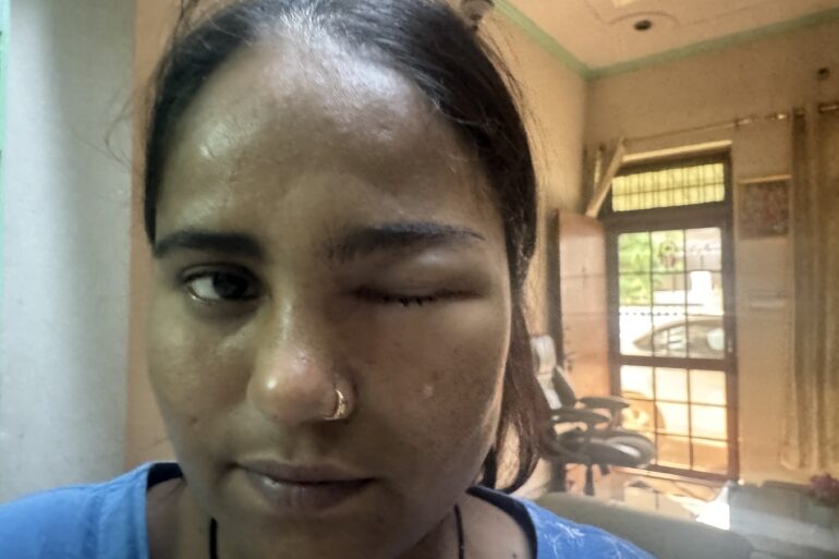 Nasolacrimal Duct Obstruction (Blocked Tear Duct)