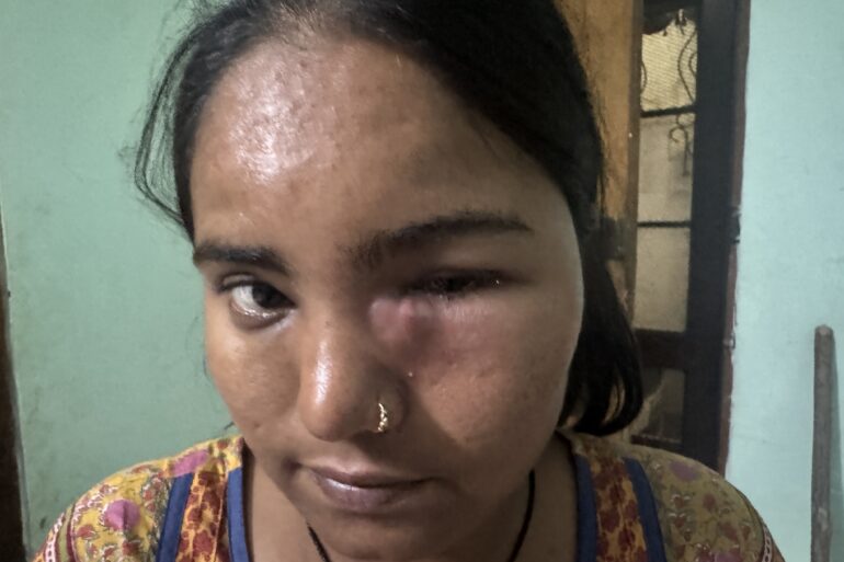 Nasolacrimal Duct Obstruction (Blocked Tear Duct)