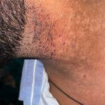 Flat Warts Cured in 15 Days Through Medicine Energy Transmission: A patient who wanted refund initially