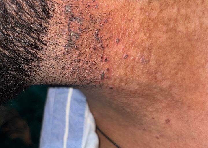 Flat Warts Cured in 15 Days Through Medicine Energy Transmission: A patient who wanted refund initially