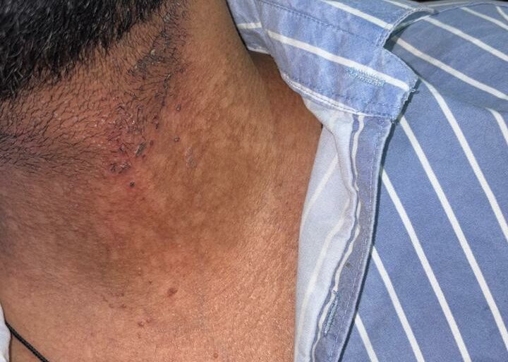 Flat Warts Cured in 15 Days Through Medicine Energy Transmission: A patient who wanted refund initially