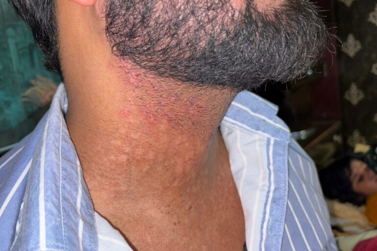 Flat Warts Cured in 15 Days Through Medicine Energy Transmission: A patient who wanted refund initially