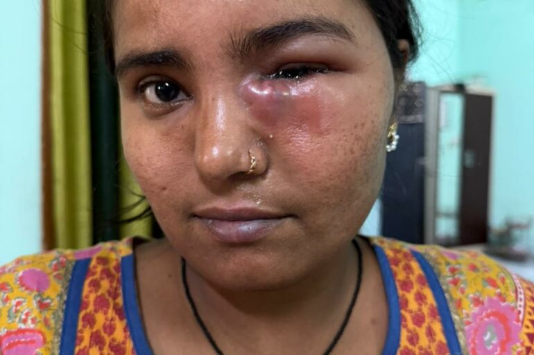 Nasolacrimal Duct Obstruction (Blocked Tear Duct)