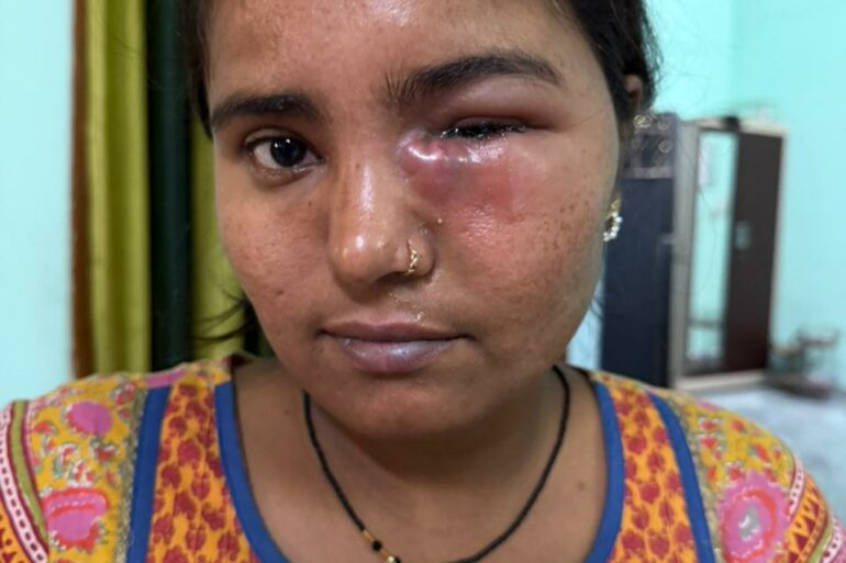 Nasolacrimal Duct Obstruction (Blocked Tear Duct)