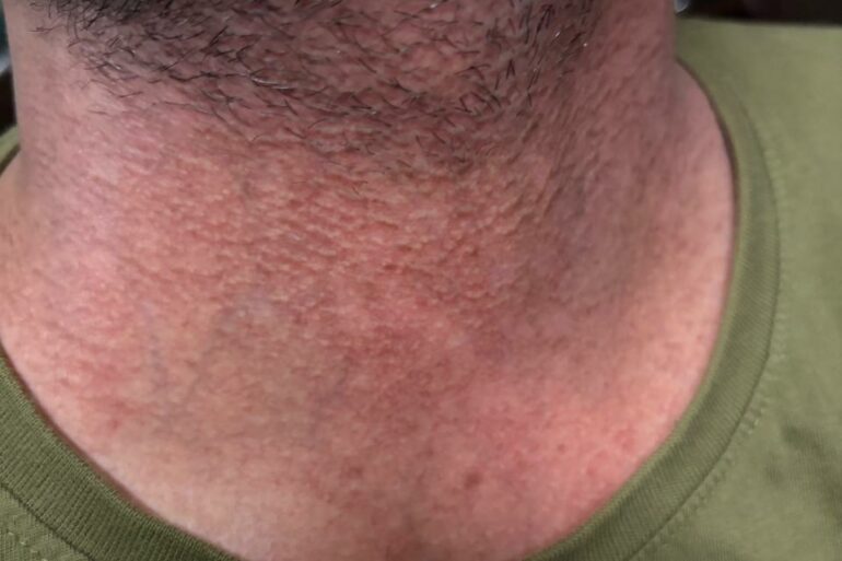 Flat Warts Cured in 15 Days Through Medicine Energy Transmission: A patient who wanted refund initially