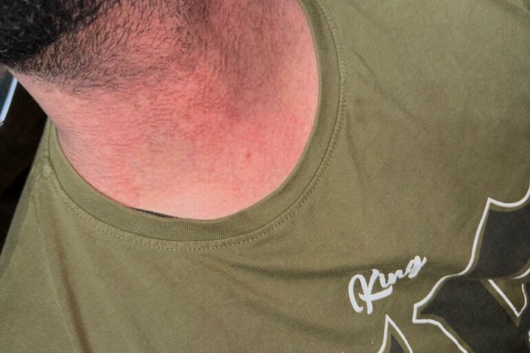 Flat Warts Cured in 15 Days Through Medicine Energy Transmission: A patient who wanted refund initially