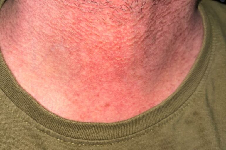Flat Warts Cured in 15 Days Through Medicine Energy Transmission: A patient who wanted refund initially