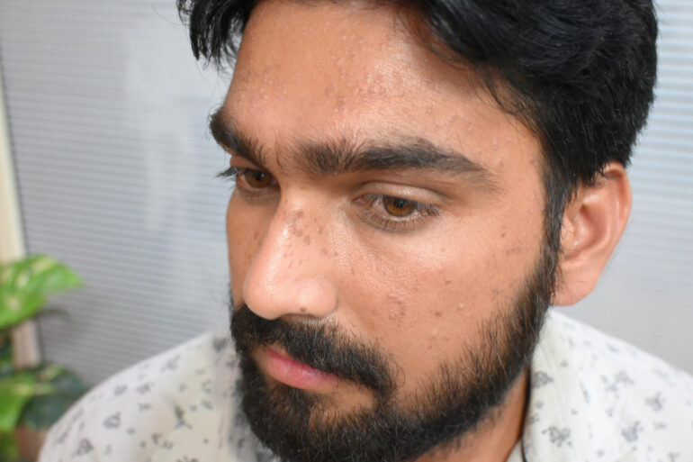 Successful Treatment of Flat Warts via Energy Transmission Case from Gonda