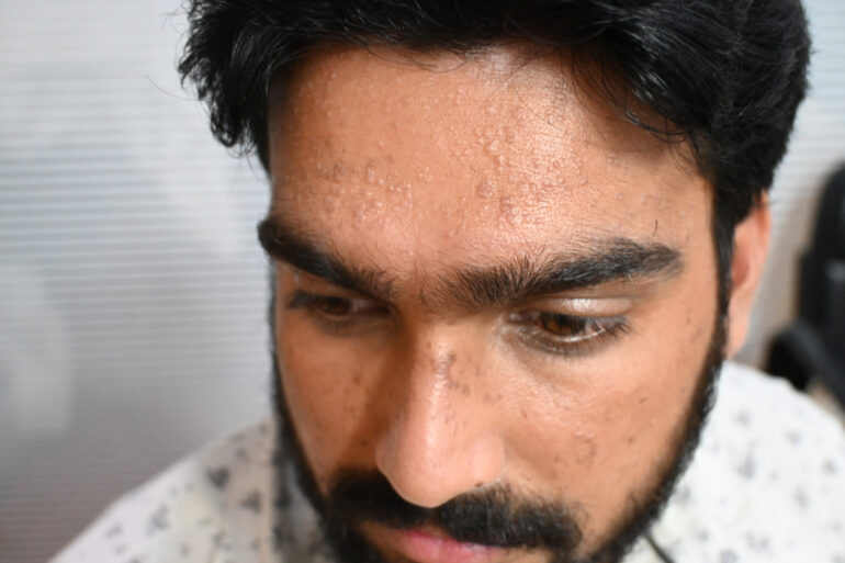 Successful Treatment of Flat Warts via Energy Transmission Case from Gonda