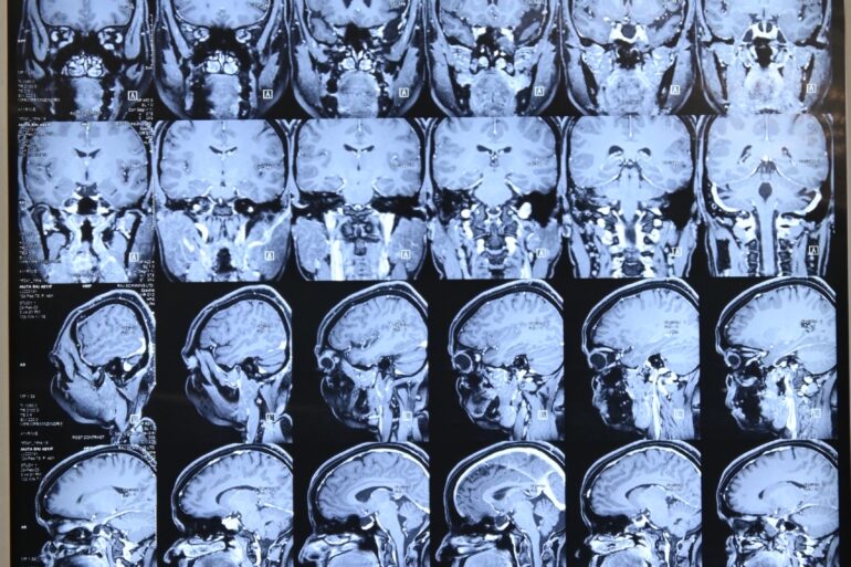 Long-Term Relief in Recurrent Cerebrospinal Fluid (CSF) Rhinorrhea After Failed Surgical Procedures Through Individualized Homoeopathy and Medicine Transmission Through Hair: A Case Study