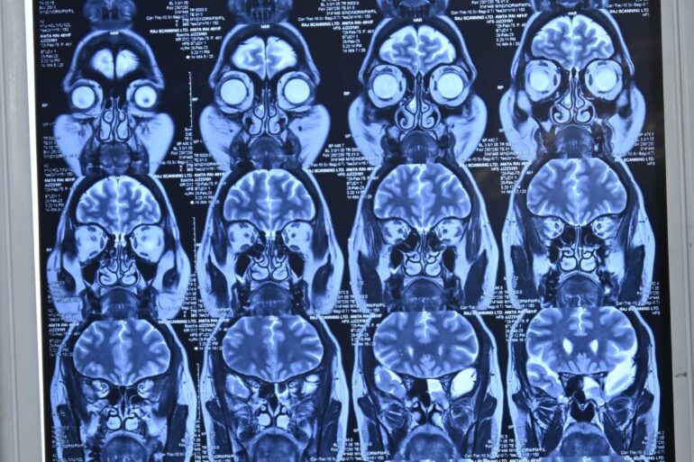 Long-Term Relief in Recurrent Cerebrospinal Fluid (CSF) Rhinorrhea After Failed Surgical Procedures Through Individualized Homoeopathy and Medicine Transmission Through Hair: A Case Study
