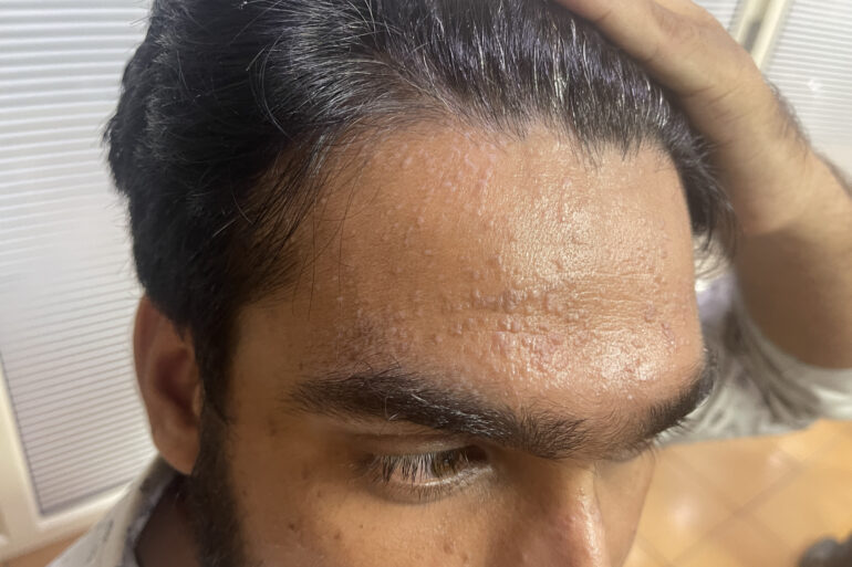Successful Treatment of Flat Warts via Energy Transmission Case from Gonda