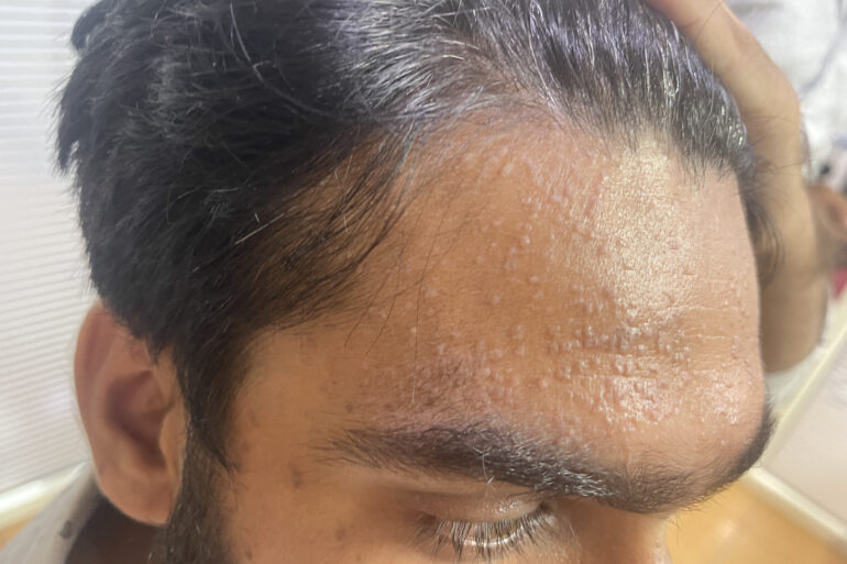 Successful Treatment of Flat Warts via Energy Transmission Case from Gonda