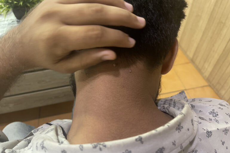 Successful Treatment of Flat Warts via Energy Transmission Case from Gonda