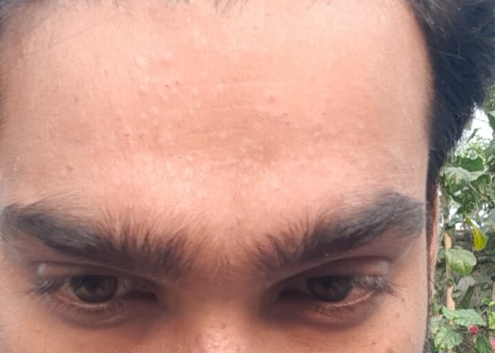 Successful Treatment of Flat Warts via Energy Transmission Case from Gonda