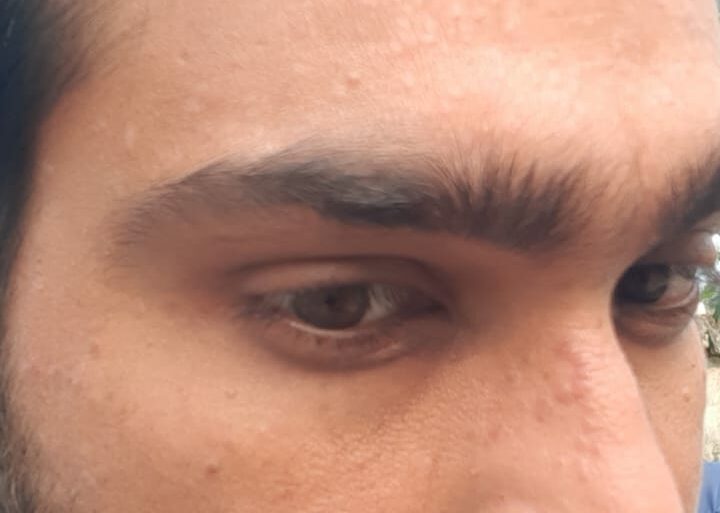 Successful Treatment of Flat Warts via Energy Transmission Case from Gonda