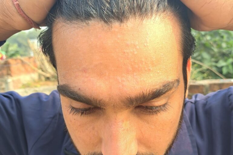 Successful Treatment of Flat Warts via Energy Transmission Case from Gonda