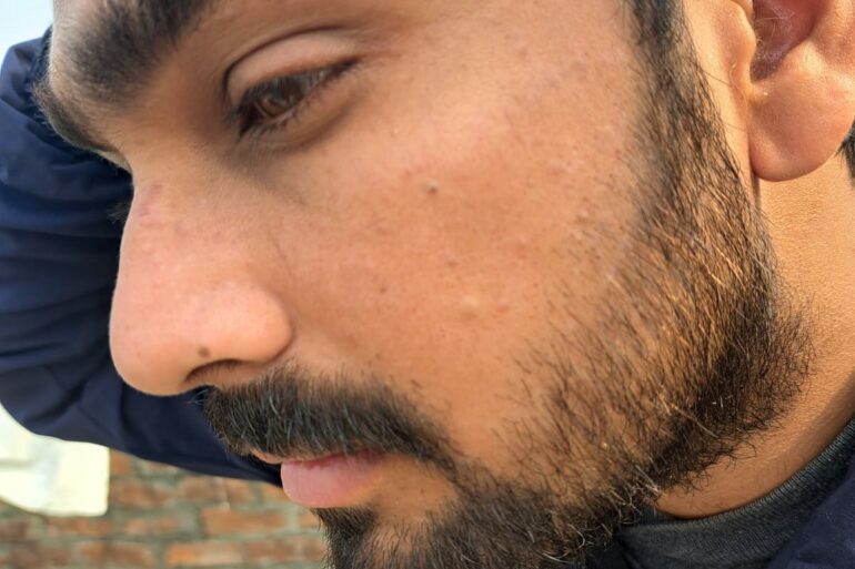 Successful Treatment of Flat Warts via Energy Transmission Case from Gonda