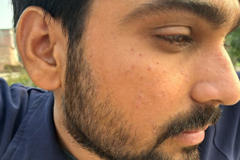 Successful Treatment of Flat Warts via Energy Transmission Case from Gonda
