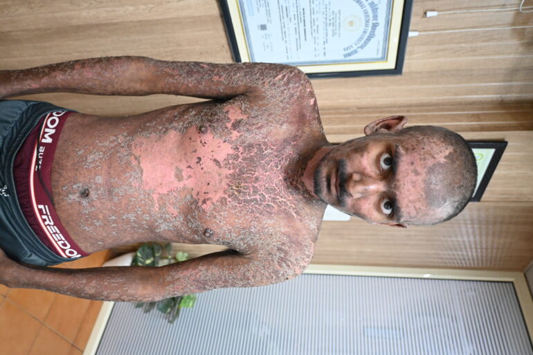 Wonderful Improvement in Horrible skin condition