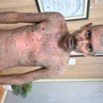 Wonderful Improvement in Horrible skin condition