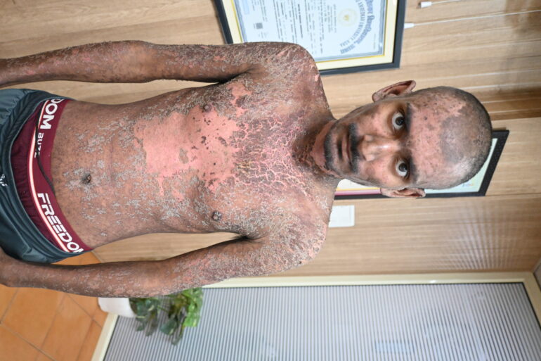 Wonderful Improvement in Horrible skin condition