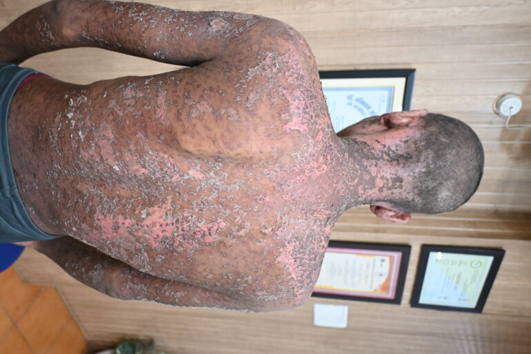 Wonderful Improvement in Horrible skin condition