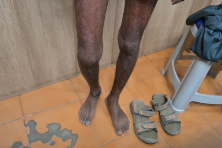 Wonderful Improvement in Horrible skin condition