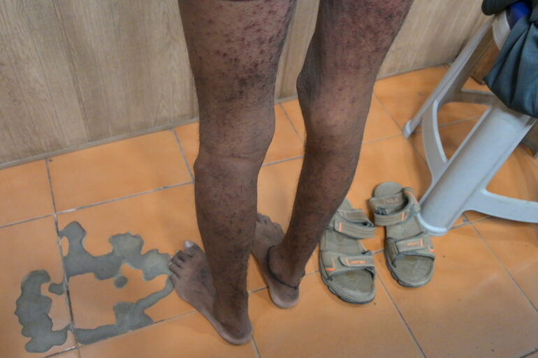 Wonderful Improvement in Horrible skin condition