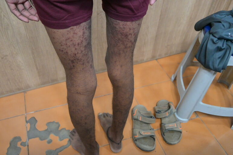 Wonderful Improvement in Horrible skin condition