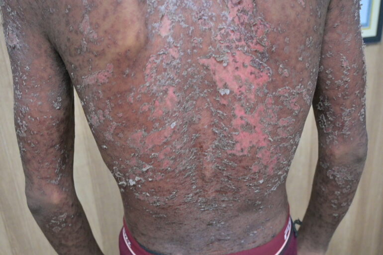 Wonderful Improvement in Horrible skin condition