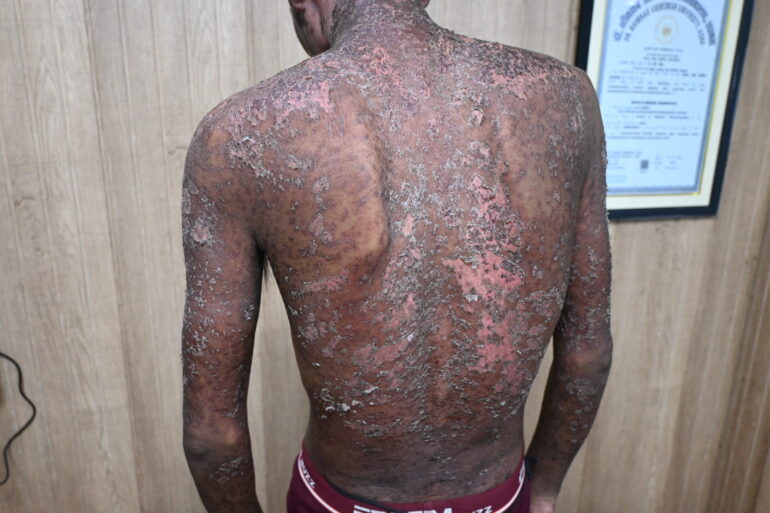 Wonderful Improvement in Horrible skin condition