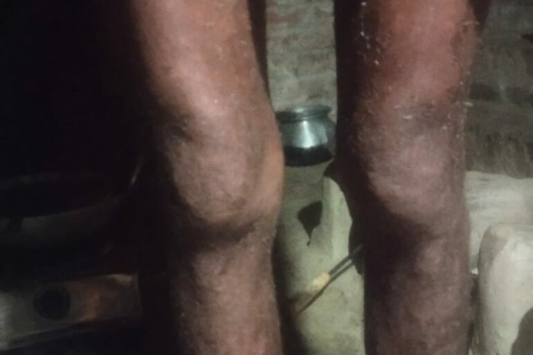 Wonderful Improvement in Horrible skin condition