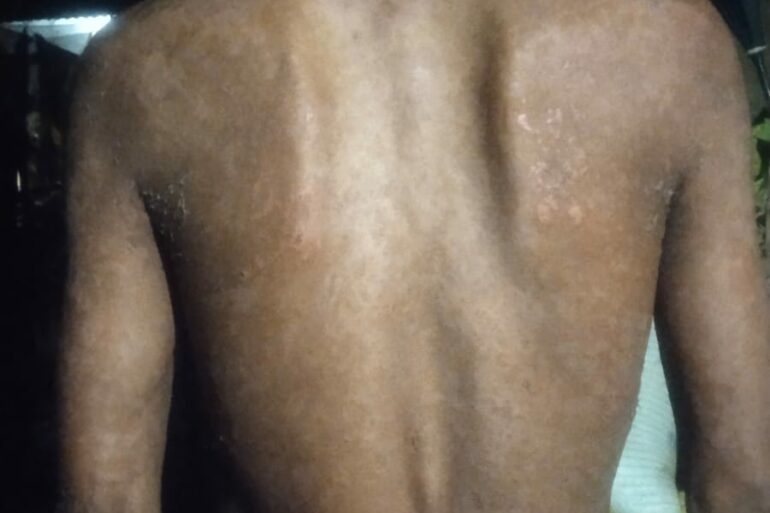 Wonderful Improvement in Horrible skin condition
