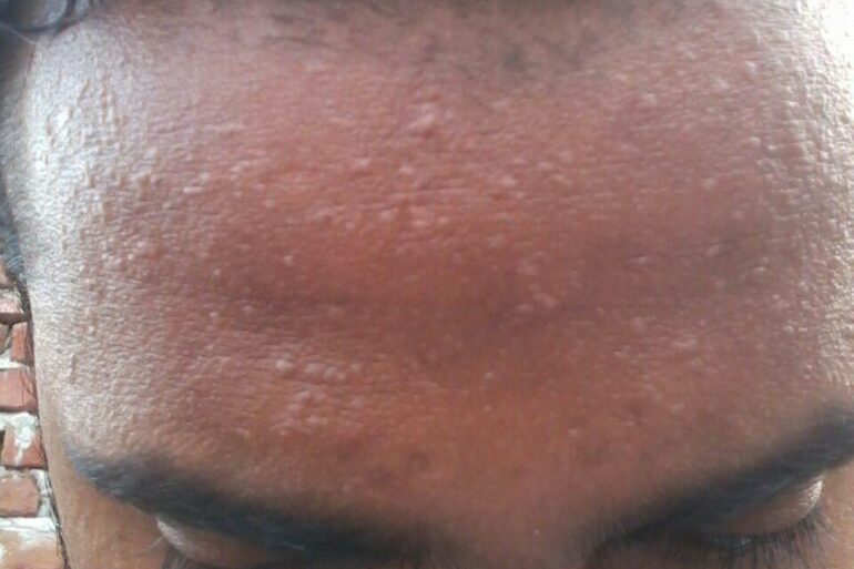 A case of Flat warts or Veruca Plana- case from Agra