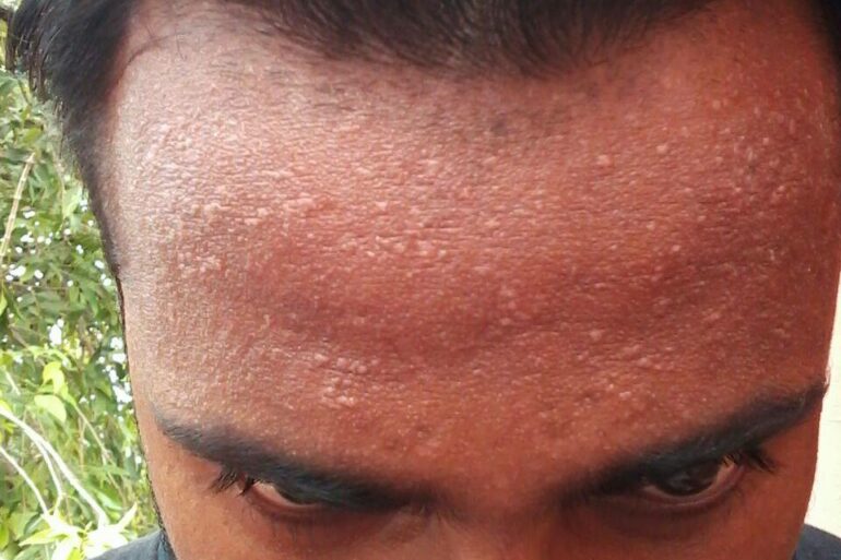 A case of Flat warts or Veruca Plana- case from Agra