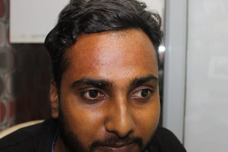 A case of Flat warts or Veruca Plana- case from Agra