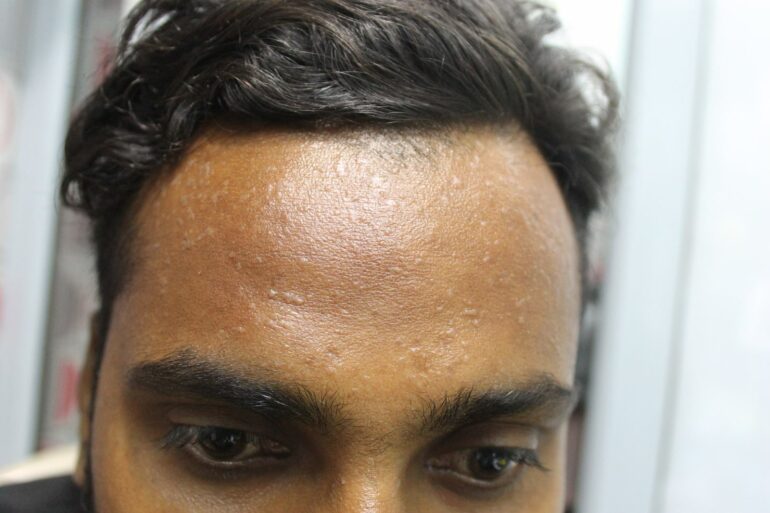 A case of Flat warts or Veruca Plana- case from Agra