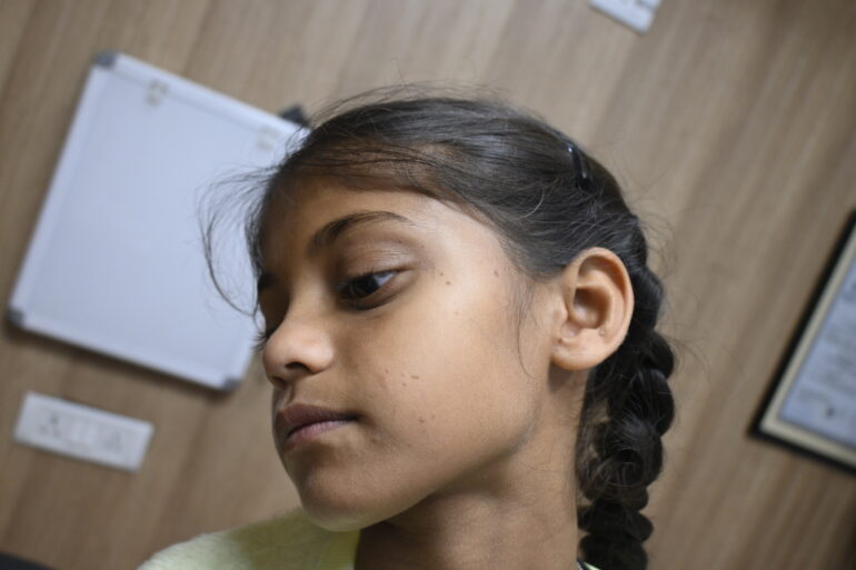 Flat warts for 4 years cured quickly with Homeopathy A case from Unnao